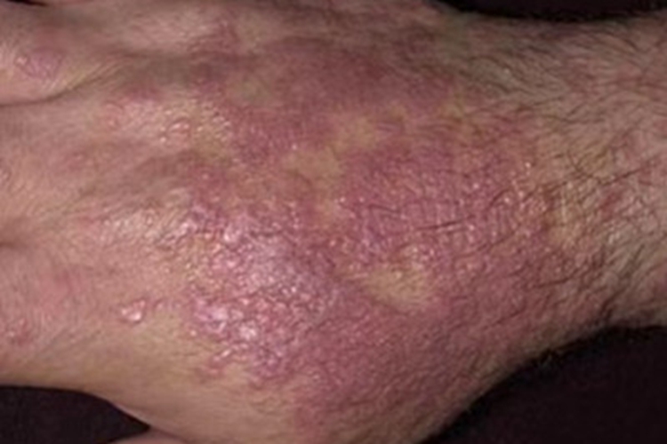 扁平苔藓手背紫红色斑片图