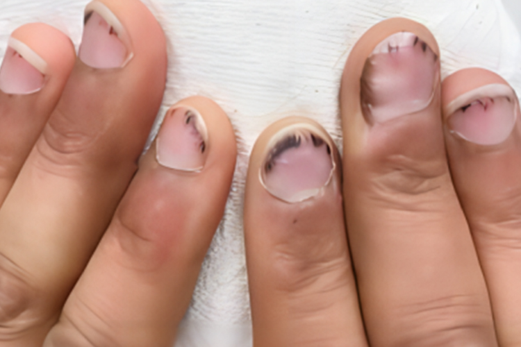 心内膜破坏指甲出血图 心内膜破坏指甲出血图