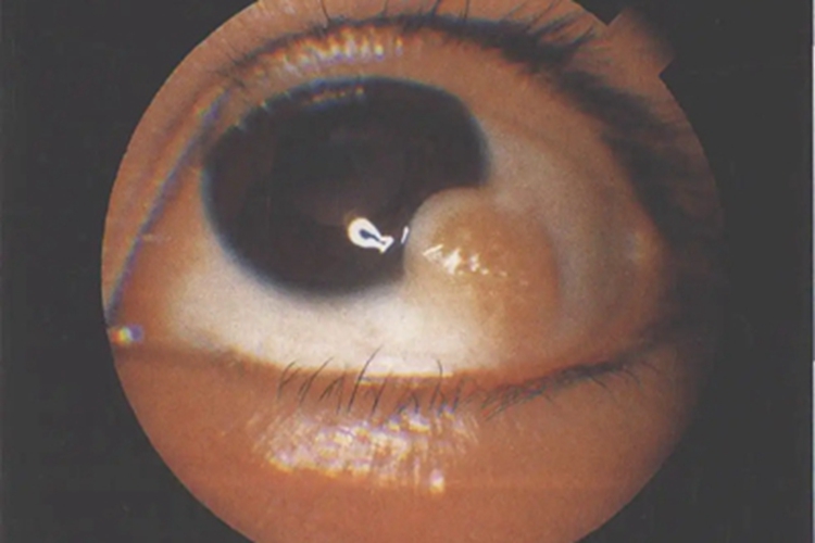 角膜皮样瘤肿块图