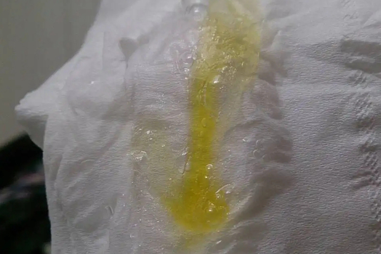 绿脓杆菌肺炎的黄色浓稠痰图