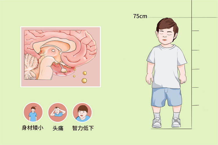 生长缓慢性矮小图