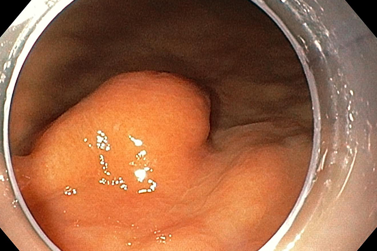 胃外壁神经纤维瘤图