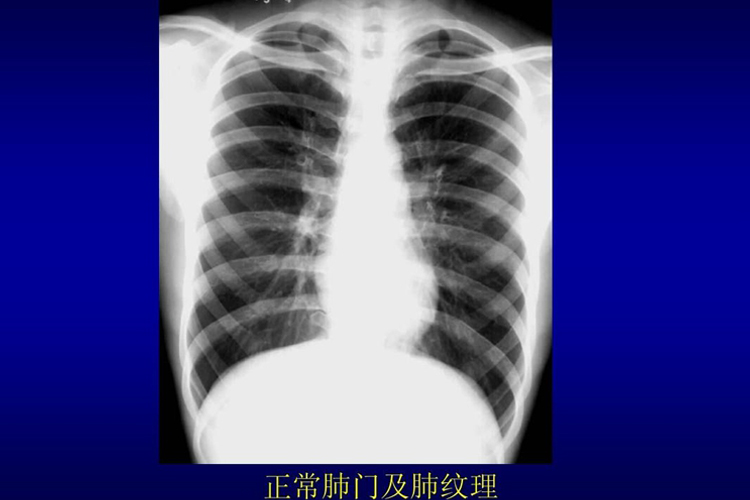 正常肺CT图 正常肺CT图