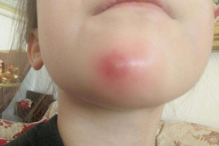 孩子右下巴疖图 孩子右下巴疖图