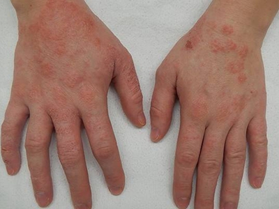 hiv感染初期症状皮肤图片
