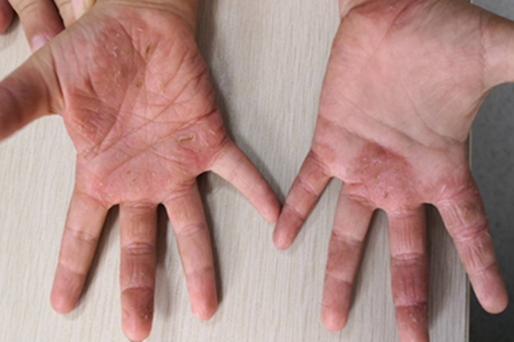 特应性皮炎手掌症状图