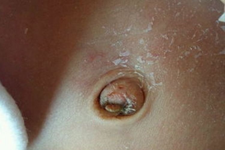 正常新生儿脐带脱落后图