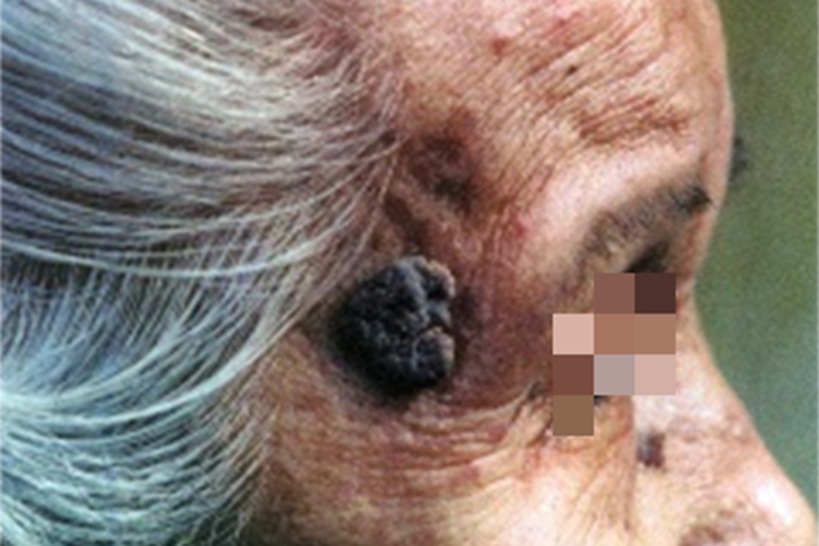 疣状脂溢性角化症大疙瘩图