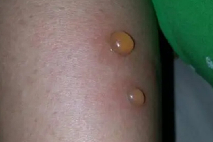 幼年型类天疱疮水疱图