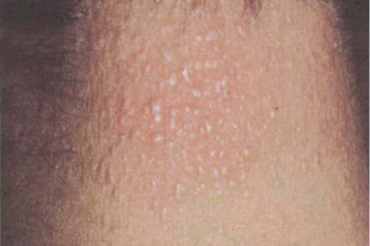 局限性黏液水肿性苔藓后颈丘疹图