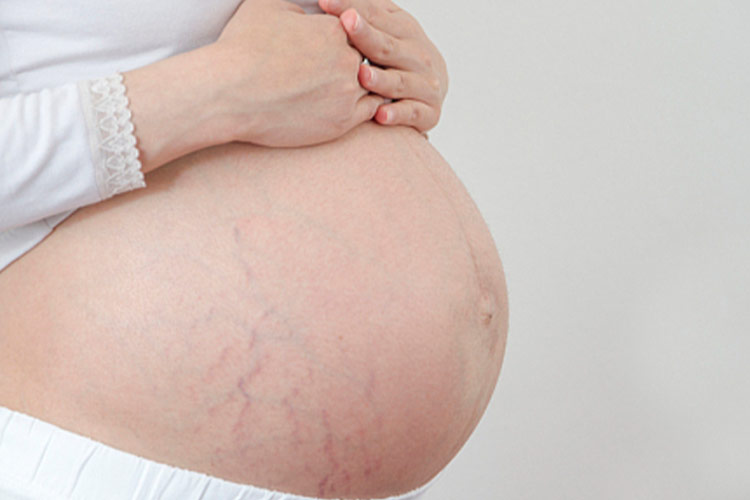 腹部妊娠纹图