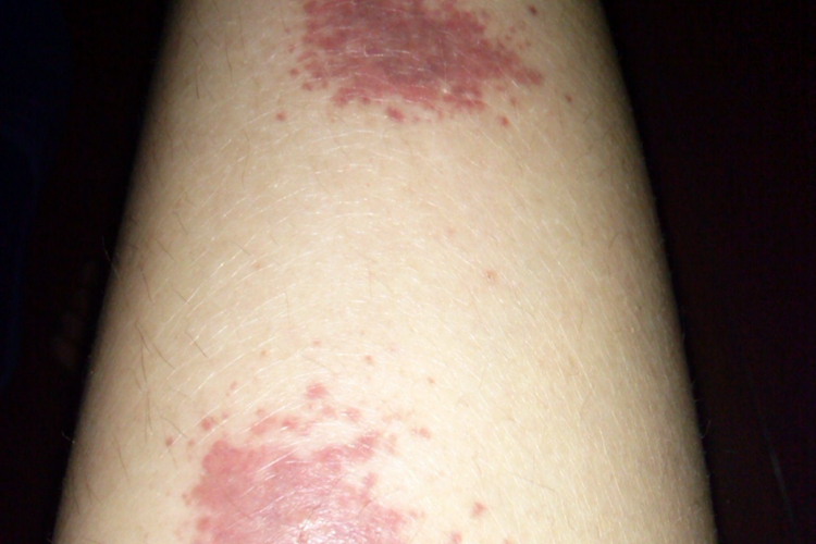 毒虫叮咬后的症状图 本文由有来医生原创,经专业医师审核校对