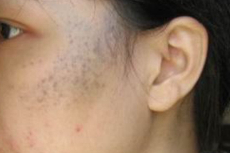 颧部褐青色痣颞部斑图 颧部褐青色痣颞部斑图