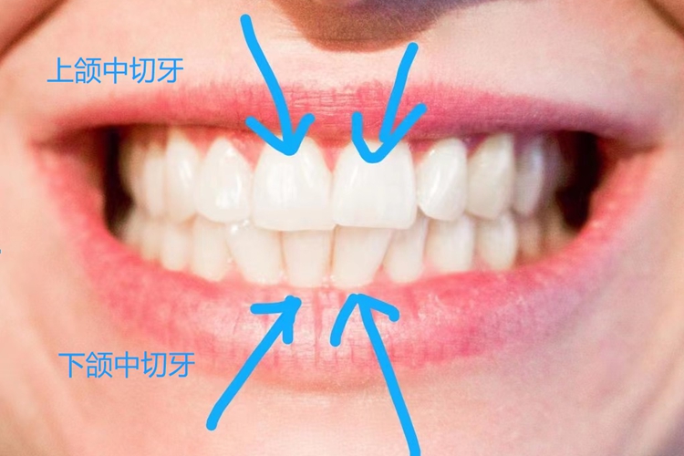 中切牙图 中切牙图