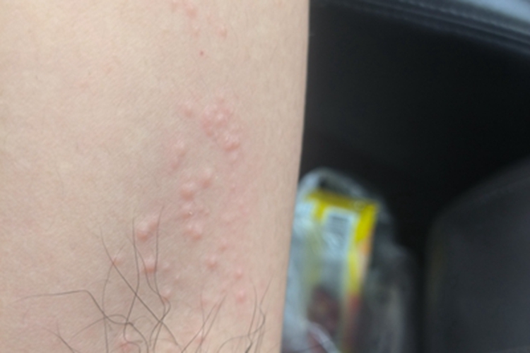 成人痒疹腋窝症状图 成人痒疹腋窝症状图