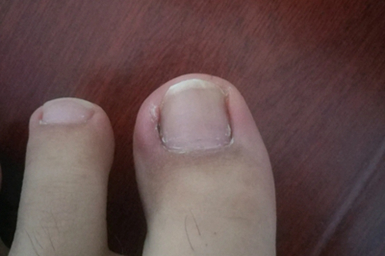 嵌甲初期图 嵌甲初期图