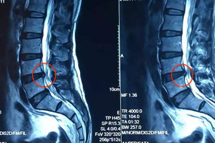 女性腰椎间盘突出影像图