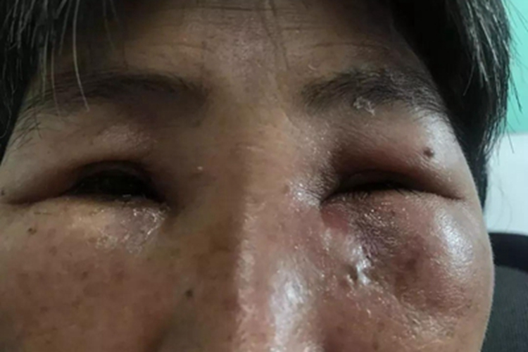 急性泪囊炎眼部症状图