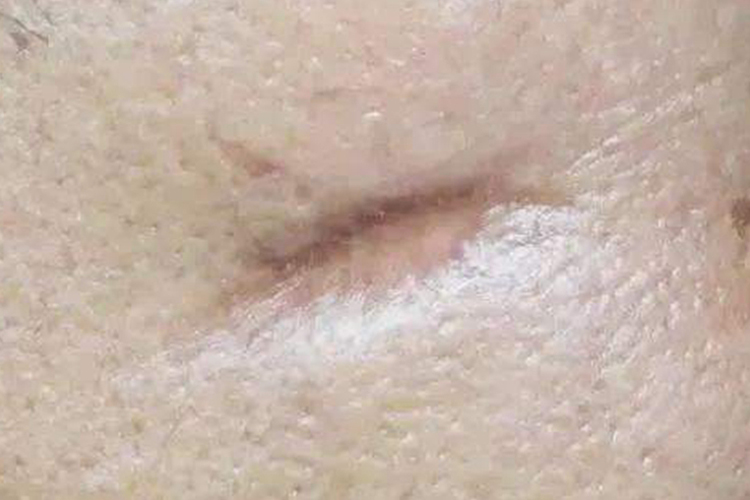 女性胸腔镜手术疤痕凹陷图