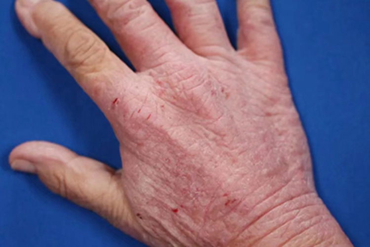 刺激性接触性皮炎手背裂口图 刺激性接触性皮炎手背裂口图