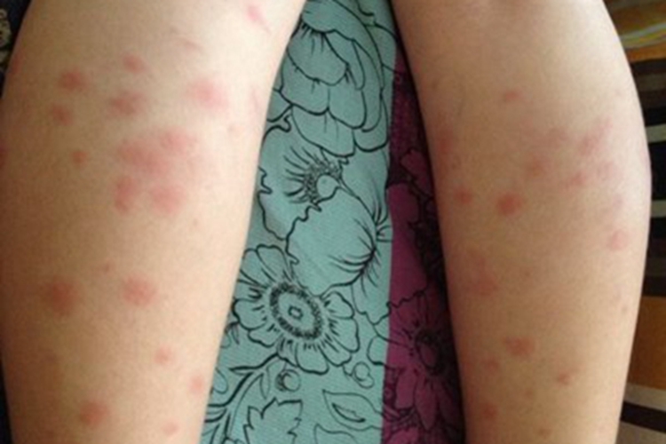 亚急性皮肤型红斑狼疮症状图