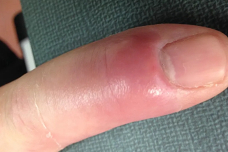 脓性指头炎手指红肿图 脓性指头炎手指红肿图