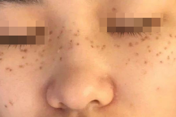 皮秒祛斑后7天图