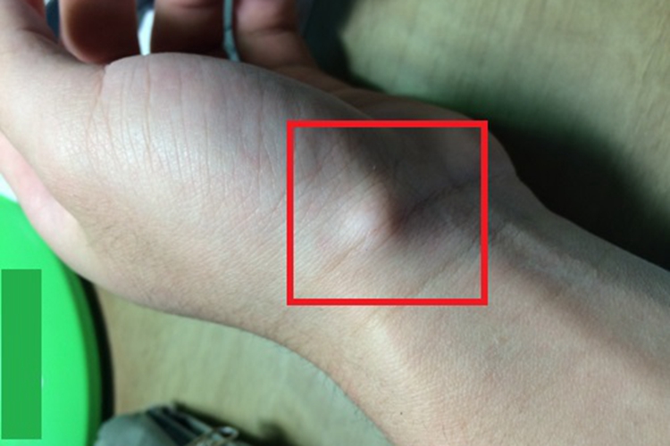 皮下纤维瘤手腕症状图 皮下纤维瘤手腕症状图