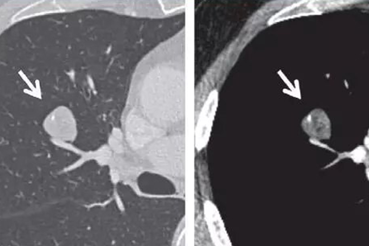 肺部错构瘤CT图