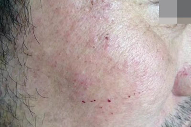 过敏性皮炎面部丘疹及血痂图 过敏性皮炎面部丘疹及血痂图