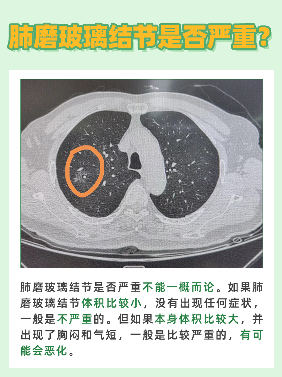 肺磨玻璃结节，严重性和治疗方法大解析