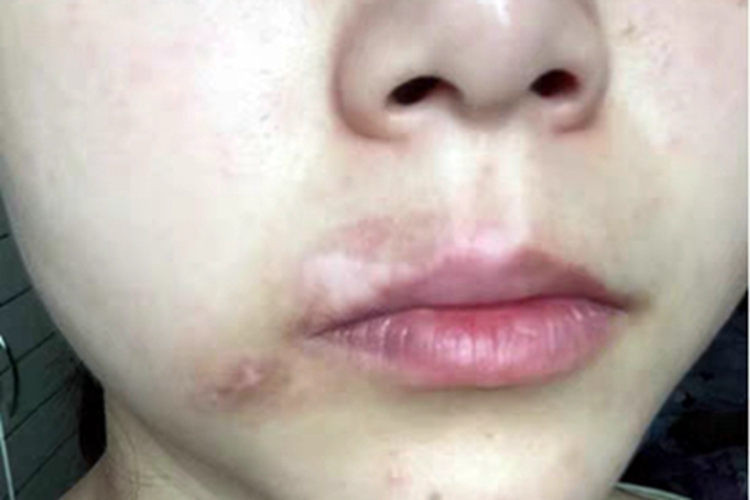 进展期节段型白癜风唇周白斑图