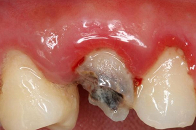 深龋牙齿缺损一半发黑图