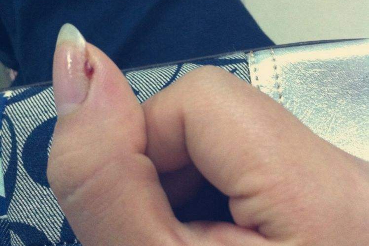 手指甲缝长肉芽甲沟炎图