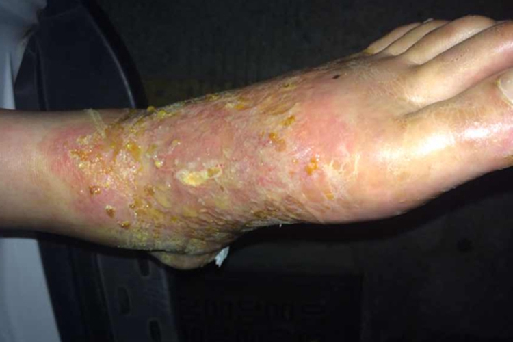 角层下脓疱性皮病脚背症状图 角层下脓疱性皮病脚背症状图
