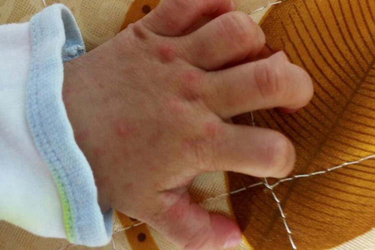 手足口病初期手部斑疹图