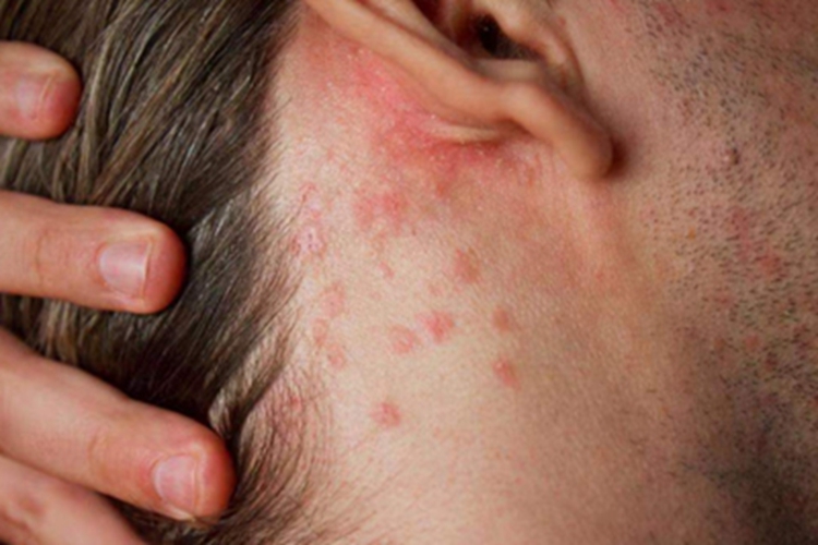 艾滋病急性感染期耳后小红疙瘩图