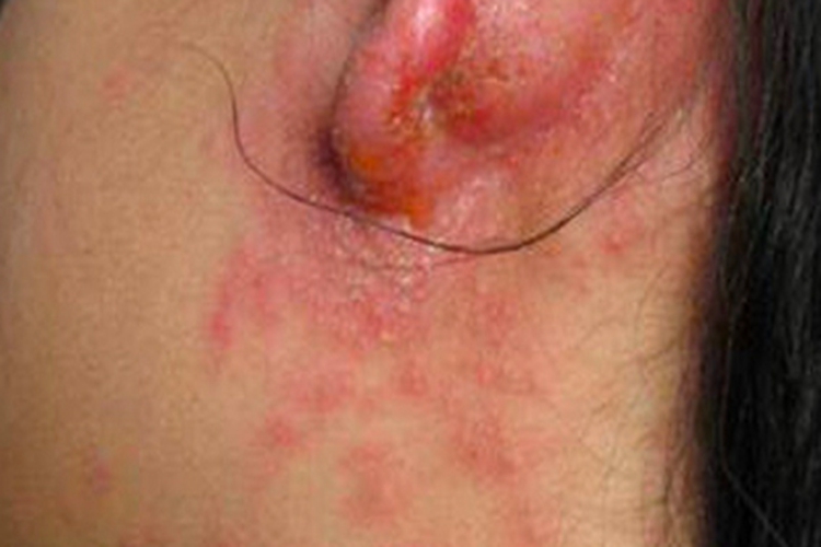 外耳湿疹耳朵后边流水图