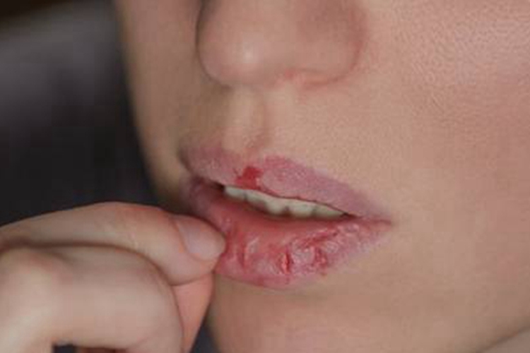 剥脱性唇炎嘴唇干裂图