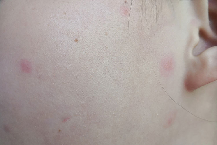 儿童水痘红色斑疹图