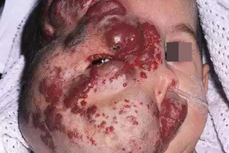 血管角化瘤面部症状图