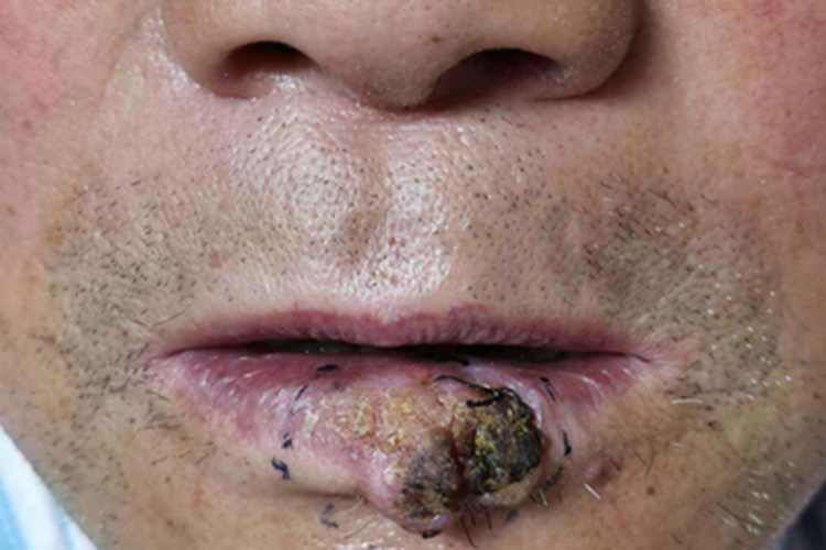 皮肤鳞状细胞癌嘴唇血痂图