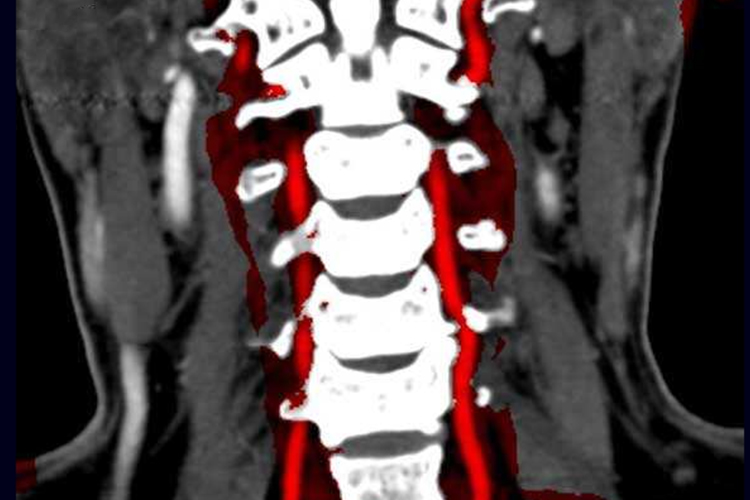 椎动脉型颈椎病图
