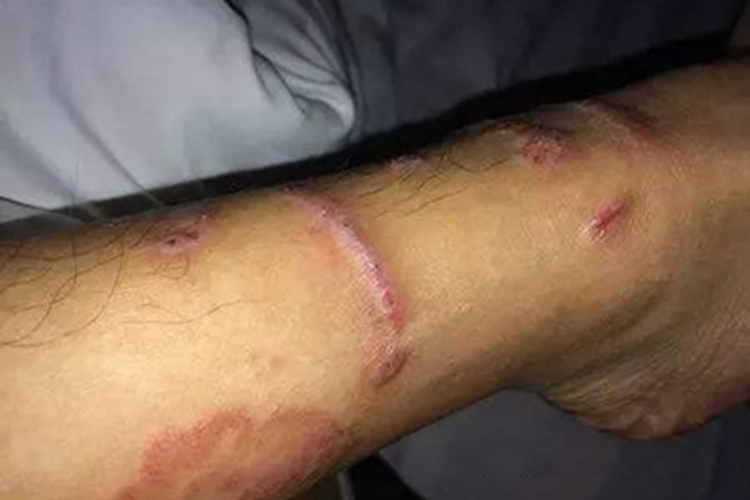 海蜇蜇伤小腿结痂图