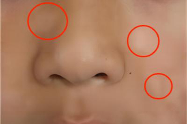 白色糠疹脸上有白斑图