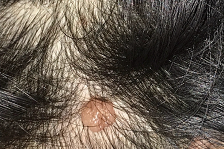 毛发囊肿头皮症状图