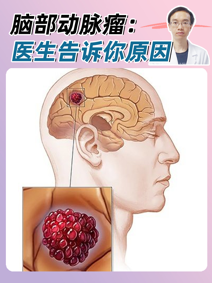 脑部动脉瘤:医生告诉你原因