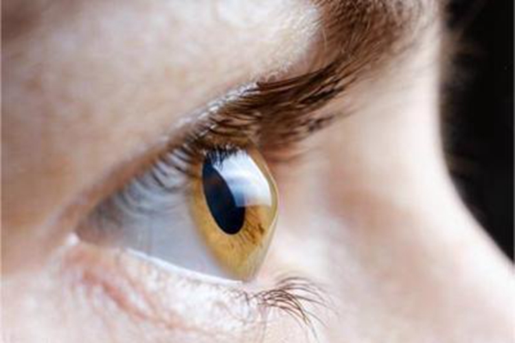 圆锥角膜角膜变锥形图 圆锥角膜角膜变锥形图