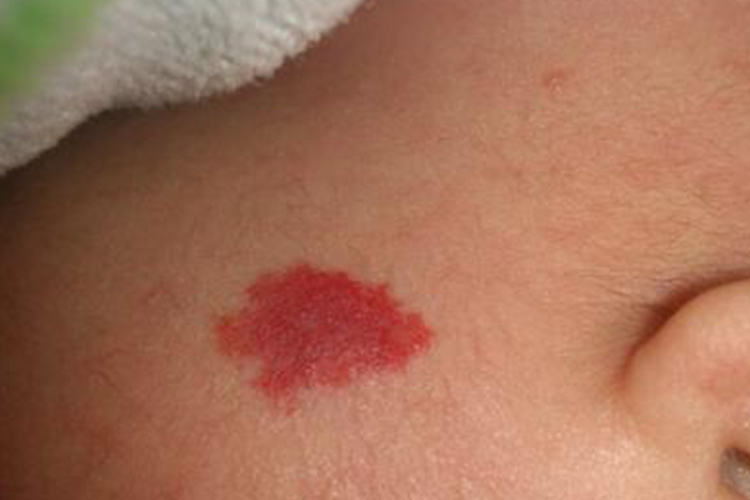 新生儿草莓状血管痣图 新生儿草莓状血管痣图