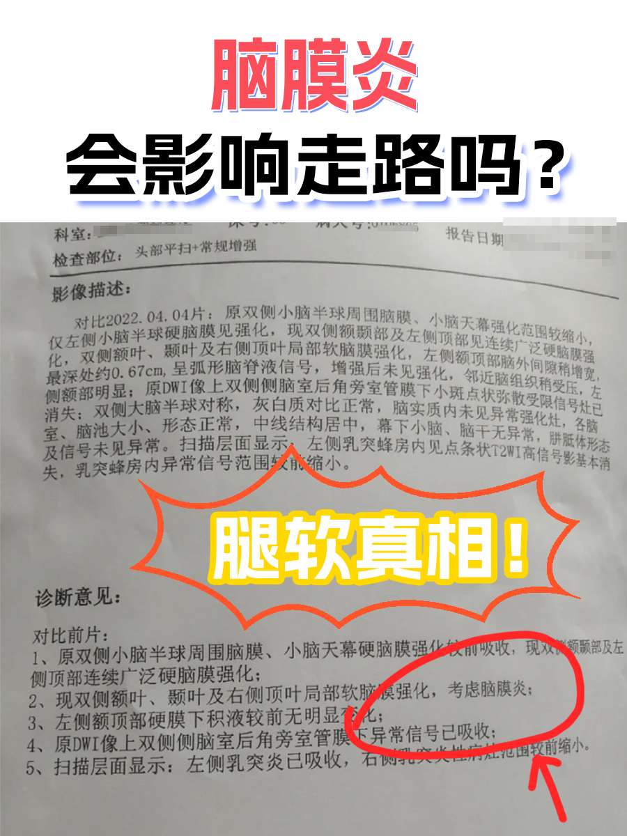 脑膜炎会影响走路吗？腿软真相！